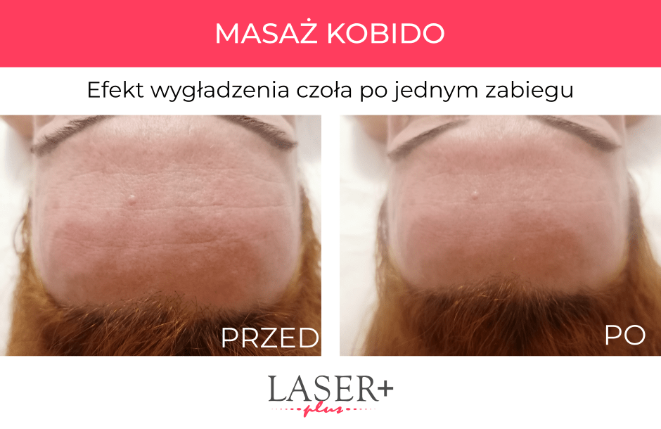Efekt masażu Kobido w salonie Laser Plus w Toruniu